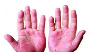 Palmoplantar pustulosis is a chronic condition affecting the palms and soles. Many people with psoriasis experience anxiety, embarrassment and depression.