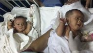 Conjoined Bangladeshi twins Tofa and Tahura after surgery to separate them at Dhaka Medical College Hospital. 