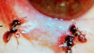 The tiny insects, which are just three milimetres (one-tenth of an inch) long, were discovered after the woman -- known only as Ms Ho -- sought treatment for an itchy and swollen left eye, Dr Horng Chi-ting said.