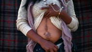 A member caravan of migrants from Central America shows a scar on her abdomen left after an operation on a bullet wound  in Tijuana, Mexico, May 1, 2018. Reuters / Edgard Garrido