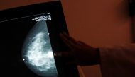 Representative image: A monitor shows the image of a breast cancer at a centre run by the Reto Group for Full Recovery of Breast Cancer in Mexico City, October 18, 2012. Reuters / Edgard Garrido