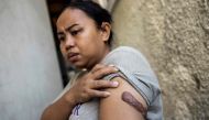 In this file photo taken on October 7, 2022, Indonesian woman Kartika Puspitasari shows a scar on her arm from an injury inflicted by previous employers, at Bethune House, a shelter operated by the migrant worker advocacy group (MFMW), in Hong Kong.(Photo by ISAAC LAWRENCE / AFP)