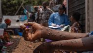 A patient suffering from mpox sits on a bench at the Kavumu hospital, 30 km north of Bukavu in eastern Democratic Republic of Congo, August 24, 2024. Photo by Glody MURHABAZI / AFP.