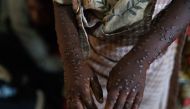 Photo for demonstration purposes. A patient with a severe form of the mpox epidemic is treated at the Kavumu hospital, 30 km north of Bukavu in eastern Democratic Republic of Congo, August 24, 2024. Photo by Glody MURHABAZI / AFP.