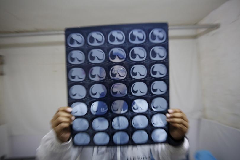 FILE PHOTO: Cancer patient Cao Dongxian poses with CT scan images of his intestine at a hotel room where he stays near the Peking Union hospital in Beijing, China, April 6, 2016 (Reuters / Kim Kyung-Hoon) 