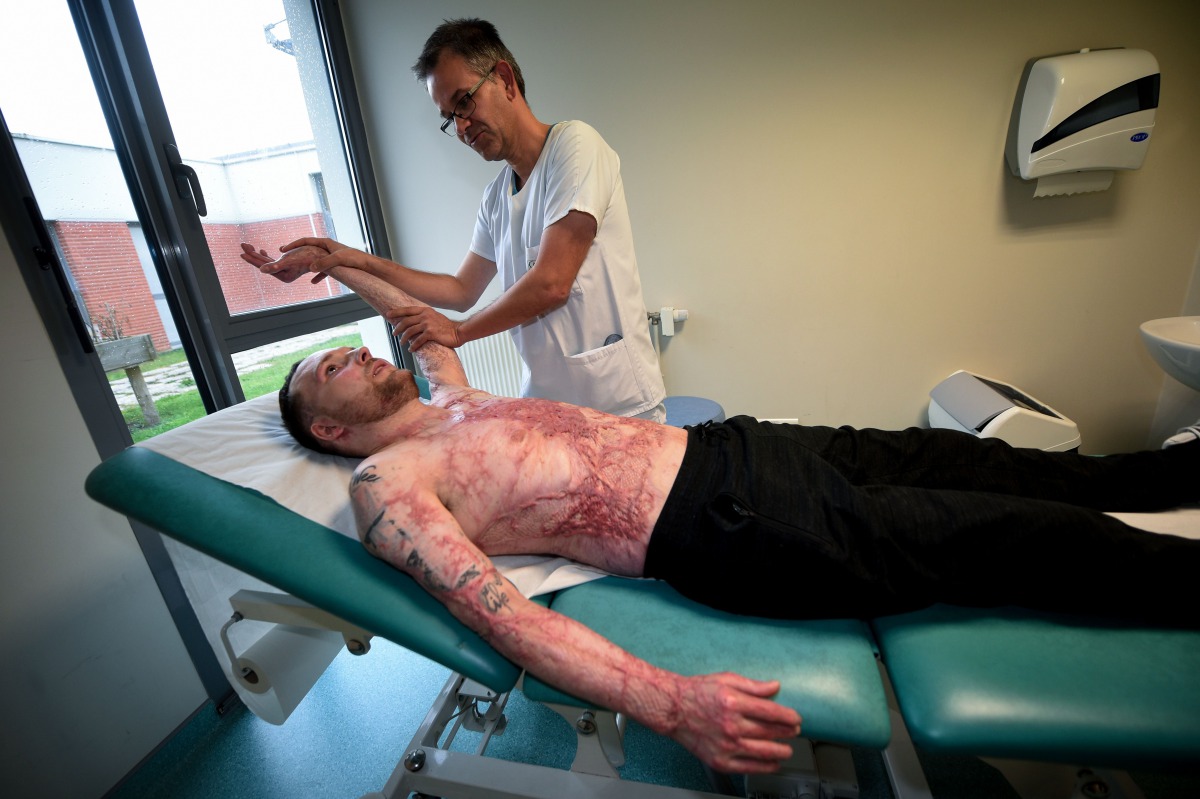 Franck, 33-year-old who had suffered burns over 95 percent of his body and was saved by a skin transplant from his identical twin Eric, in a world-first operation, receives a physiotherapy session by French physiotherapist Christophe Loisel, at the rehabi