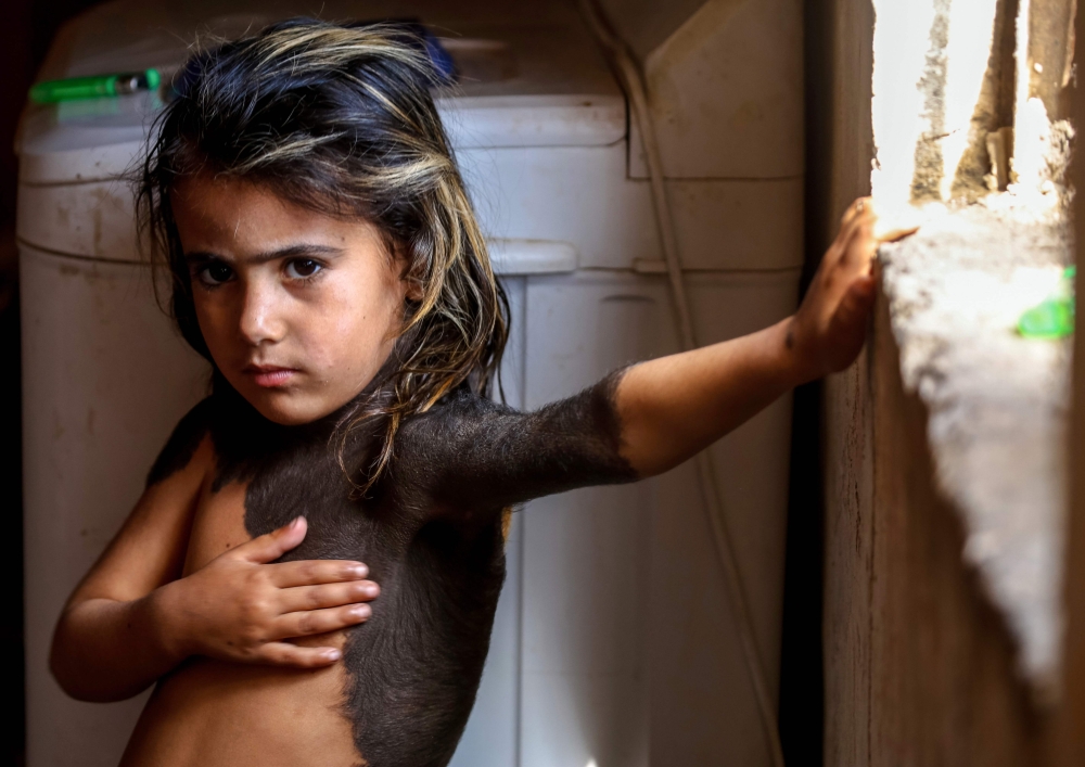 Haura, a four-year-old Iraqi child with a rare skin congenital disease that covers much of her upper body in black marks and hair, looks on as she stands in her family home in the village of Wahed Haziran, Diwaniya province, on April 17, 2018. AFP / Haida