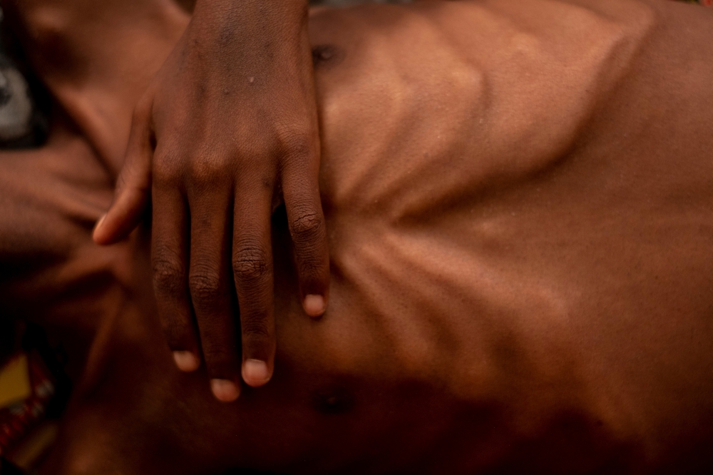 Golfi Bemonza, 4, from Bossongo, suffering from AIDS and severe acute malnutrition, is pictured at the UNICEF-supported Pediatric Clinic, in Bangui, Central African Republic September 10, 2018.  UNICEF/Ashley Gilbertson/via Reuters