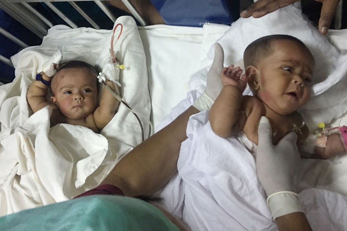 Conjoined Bangladeshi twins Tofa and Tahura after surgery to separate them at Dhaka Medical College Hospital. 