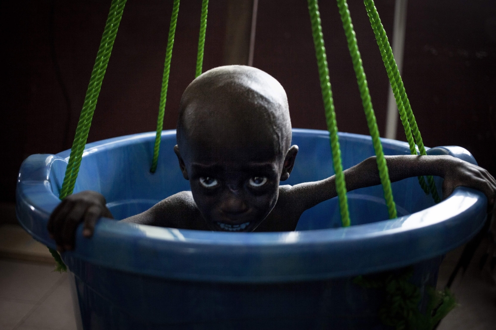 A malnourished girl cries during the daily checkweighing at the Bangui pediatric complex on December 4, 2018. / AFP / FLORENT VERGNES 
