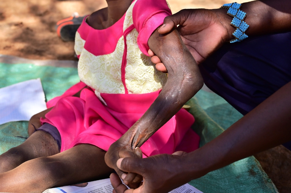 Chepchirchir Kiplagat (L), a 8-year-old child who partially lost the use of her body after a snakebit is held by her father Jackson Chepkui outside their home in the village of Embosos, in the Baringo county on February 22, 2019. / AFP / TONY KARUMBA 