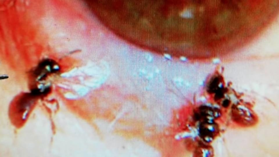 The tiny insects, which are just three milimetres (one-tenth of an inch) long, were discovered after the woman -- known only as Ms Ho -- sought treatment for an itchy and swollen left eye, Dr Horng Chi-ting said.