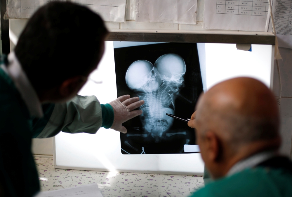FILE PHOTO: Doctors check the x-ray film of newly born conjoined twins at the child intensive care unit of al-Thawra hospital in Sanaa, Yemen, February 6, 2019. Reuters/Khaled Abdullah