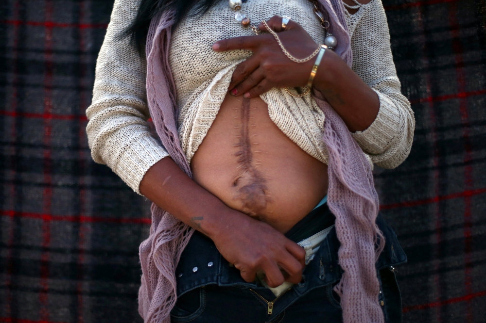 A member caravan of migrants from Central America shows a scar on her abdomen left after an operation on a bullet wound  in Tijuana, Mexico, May 1, 2018. Reuters / Edgard Garrido