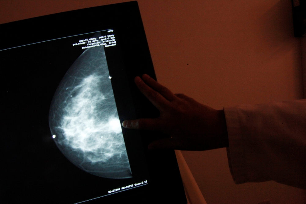 Representative image: A monitor shows the image of a breast cancer at a centre run by the Reto Group for Full Recovery of Breast Cancer in Mexico City, October 18, 2012. Reuters / Edgard Garrido