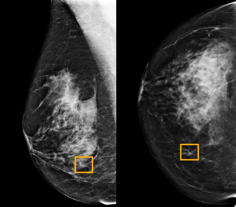 A yellow box indicates where an artificial intelligence (AI) system found cancer hiding inside breast tissue, in an undated photo released by Northwestern University in Chicago January 1, 2020. Northwestern University/Handout via Reuters