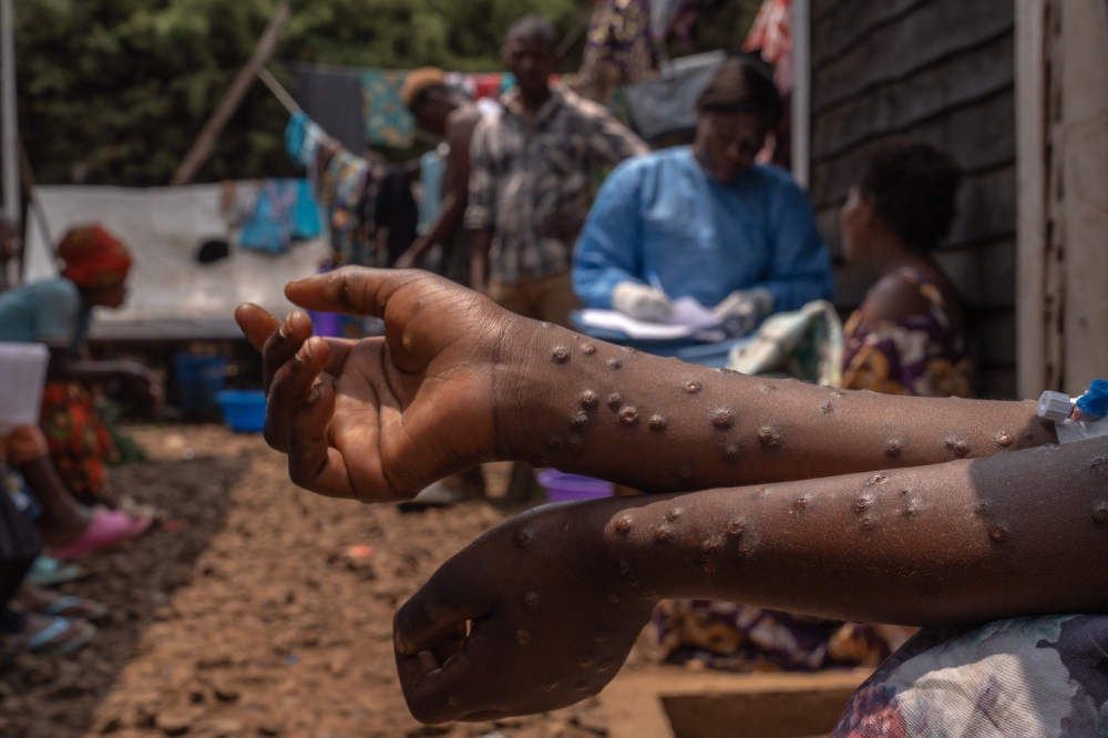 A patient suffering from mpox sits on a bench at the Kavumu hospital, 30 km north of Bukavu in eastern Democratic Republic of Congo, August 24, 2024. (Photo by Glody MURHABAZI / AFP)
