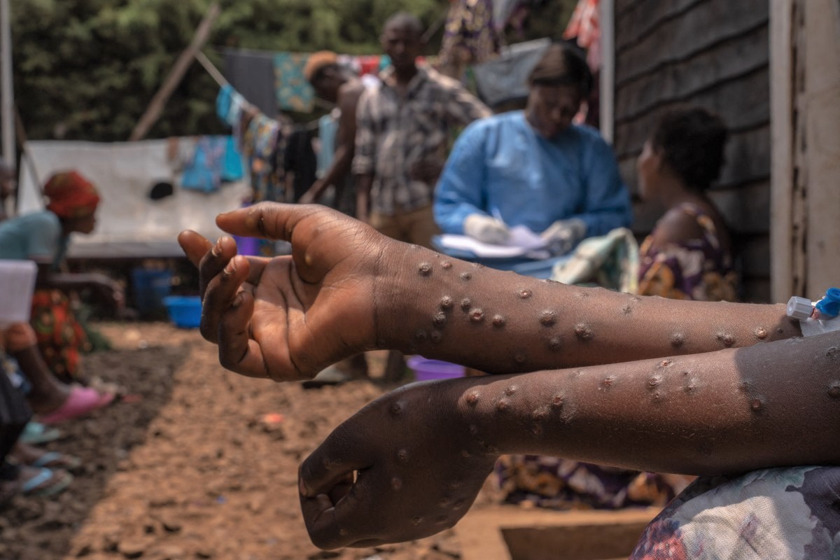 A patient suffering from mpox sits on a bench at the Kavumu hospital, north of Bukavu in eastern Democratic Republic of Congo on August 24, 2024. (Photo by Glody Murhabazi  / AFP )

